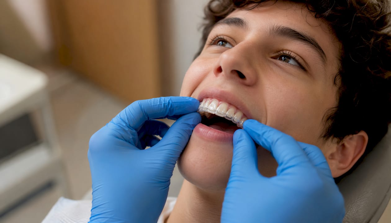 Close-up of teen teeth wearing clear aligners midline correction